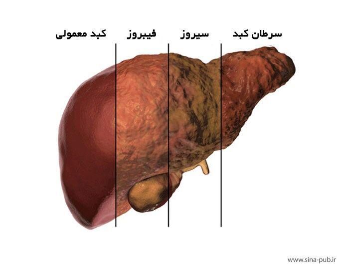 درمان کبد چرب هربال تراپی|خدمات آرایشگری و زیبایی|اسلام‌شهر, شهرک طالقانی|دیوار