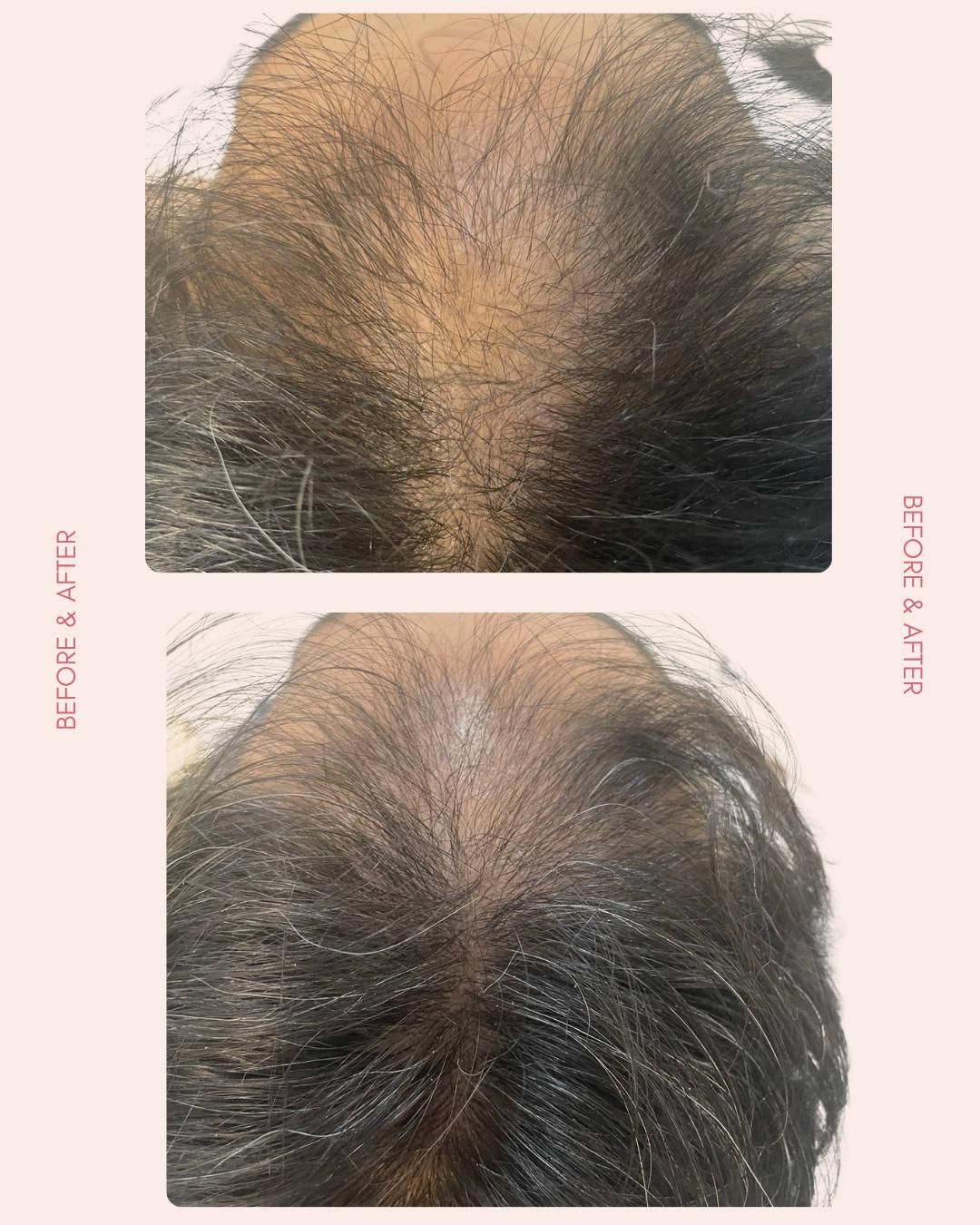 فیلر،بوتاکس،مزوتراپی،عصاره سلول بنیادی توسط پزشک|خدمات آرایشگری و زیبایی|زاهدان, |دیوار