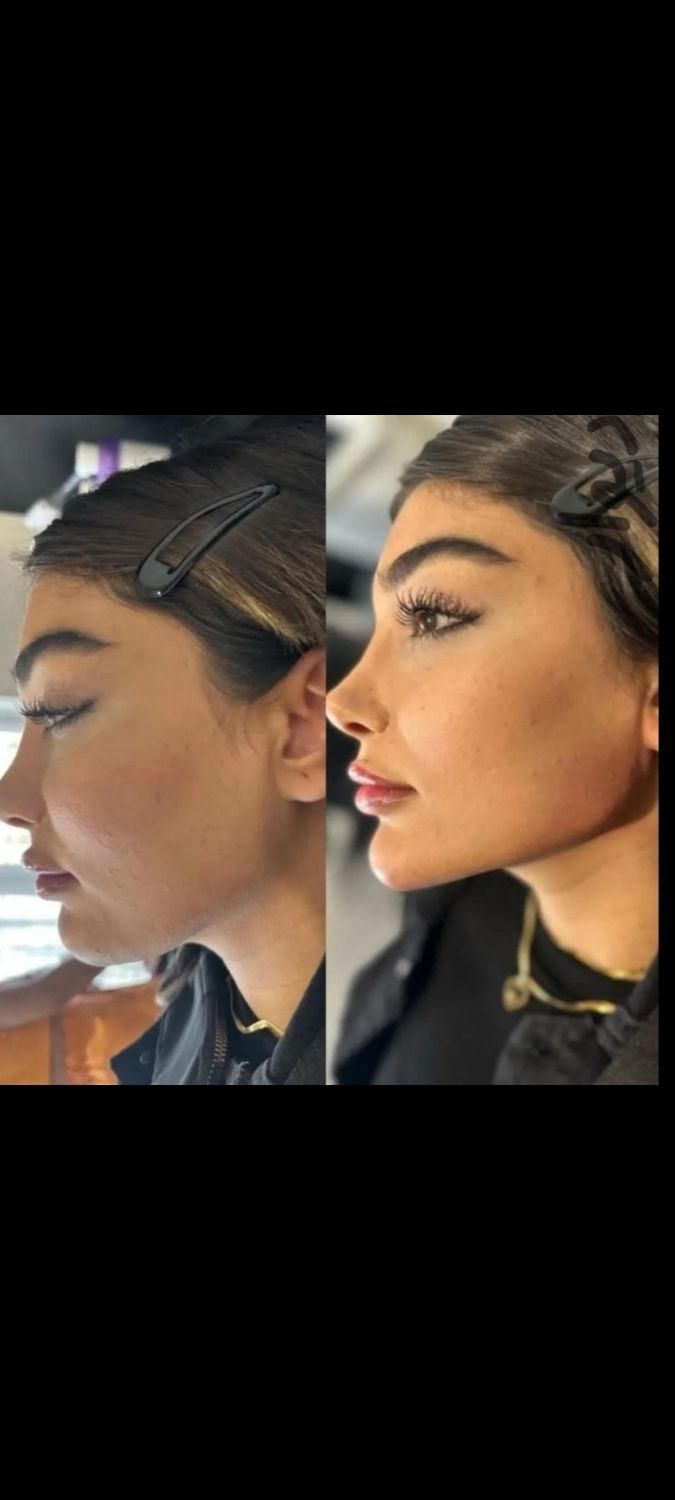 تزریق ژل و بوتاکس فقط ۵۰۰هزارتومان|خدمات آرایشگری و زیبایی|فولادشهر, B2|دیوار