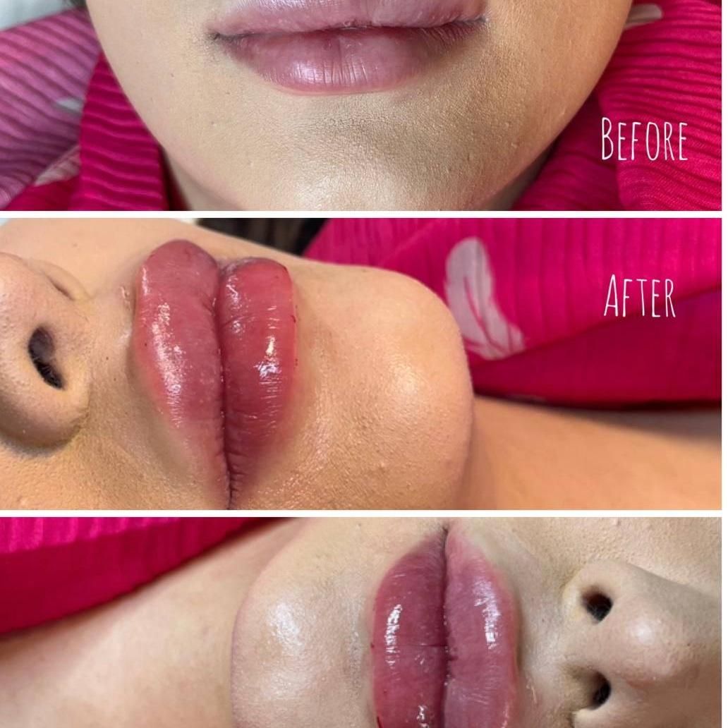 جشنواره یلدایی تزریق فیلر برند زیشل به مدت محدود|خدمات آرایشگری و زیبایی|همدان, |دیوار