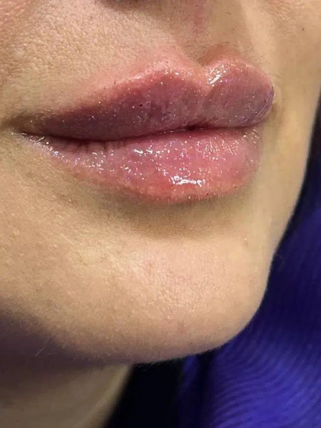 ژل بوتاکس زیبایی بینی لیفت صورت و بدن|خدمات آرایشگری و زیبایی|مشهد, هفت تیر (آب و برق)|دیوار