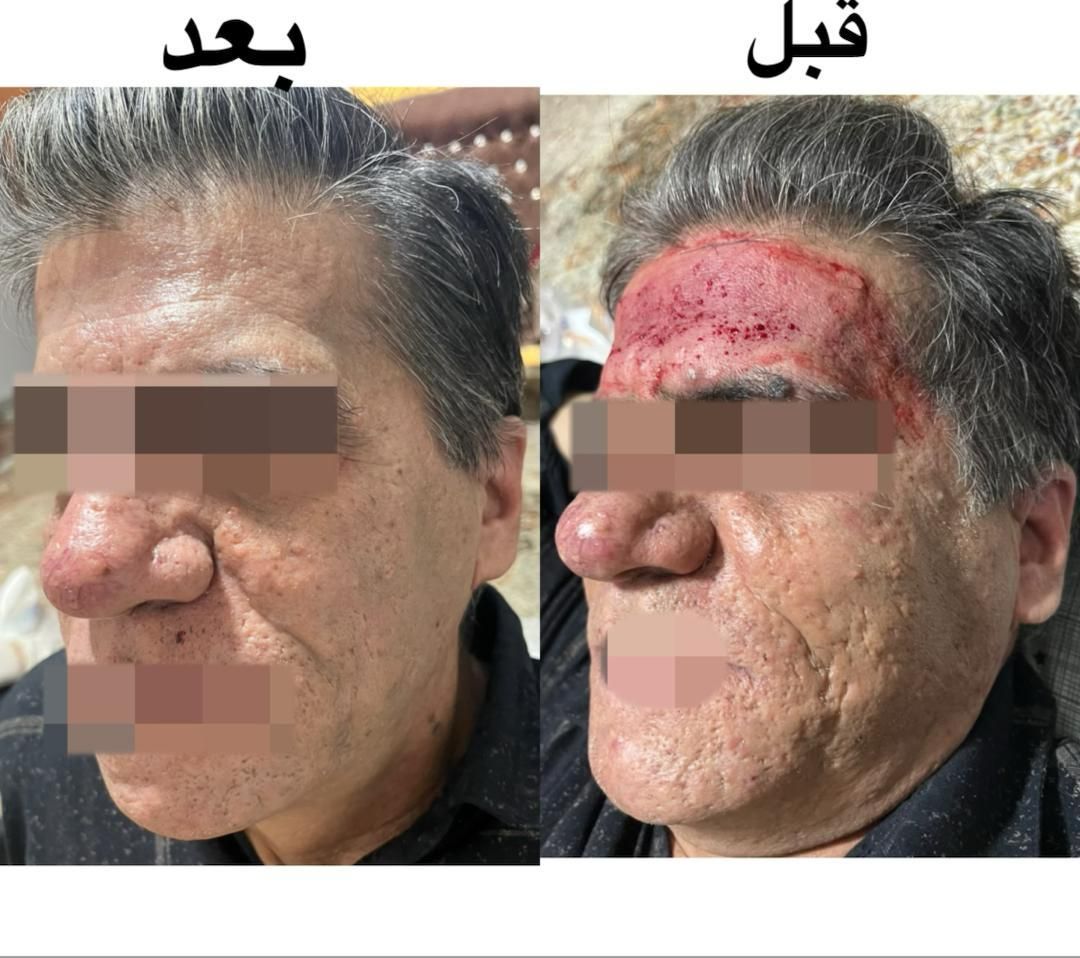 تزریق ژل بوتاکس مزونیدلینگ ، مزوسروابرو ،فیلربادی|خدمات آرایشگری و زیبایی|تهران, نیروی هوایی (پیروزی)|دیوار