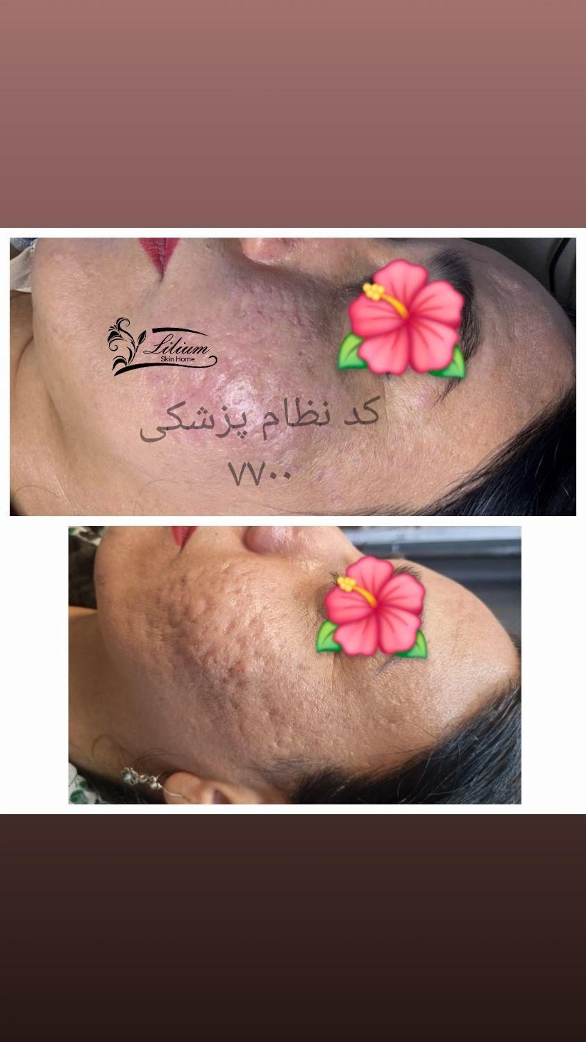 رفع جای جوش تضمینی|خدمات آرایشگری و زیبایی|اصفهان, وحید|دیوار