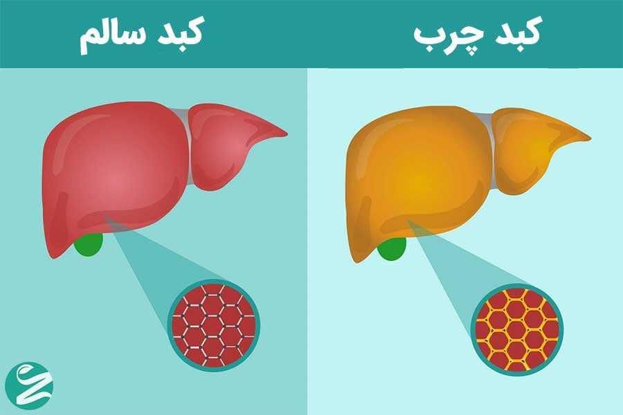 درمان کبد چرب کاملا گیاهی|آرایشی، بهداشتی، درمانی|تبریز, |دیوار