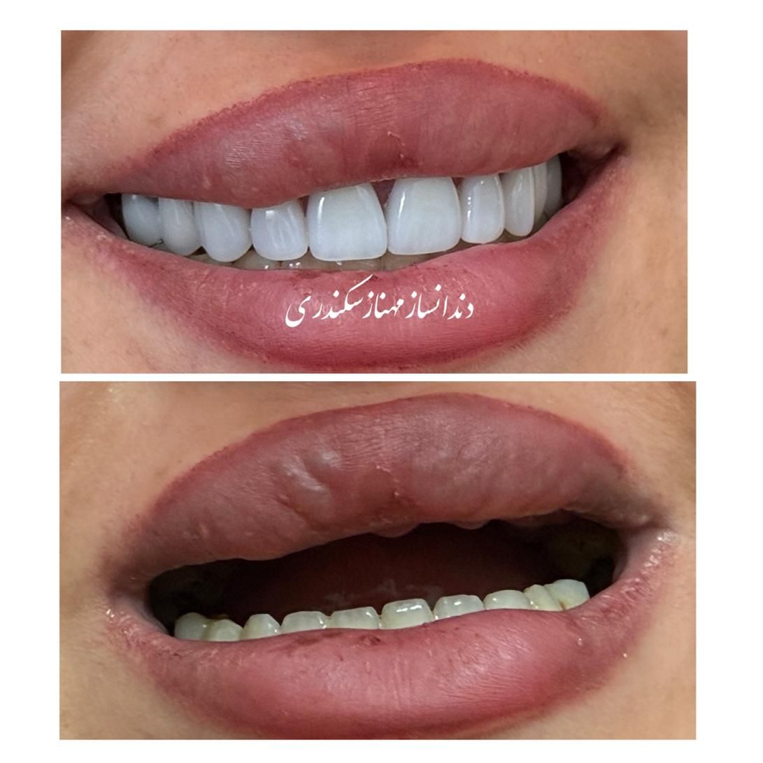 دندانسازی سکندری کرمان دندان ایتالیایی لثه نرم|خدمات آرایشگری و زیبایی|کرمان, |دیوار