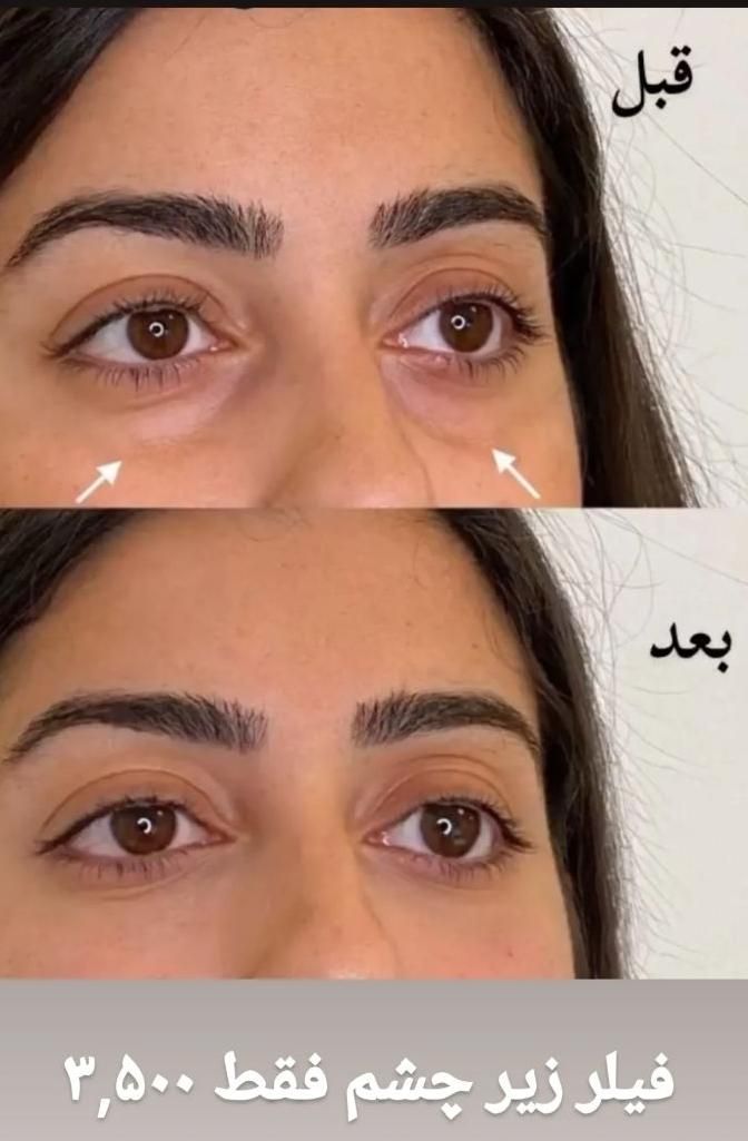 ژل لب زاویه چانه گونه  مزوبوتاکس هایفو لیزرمو زائد|خدمات آرایشگری و زیبایی|مشهد, فرهنگ|دیوار