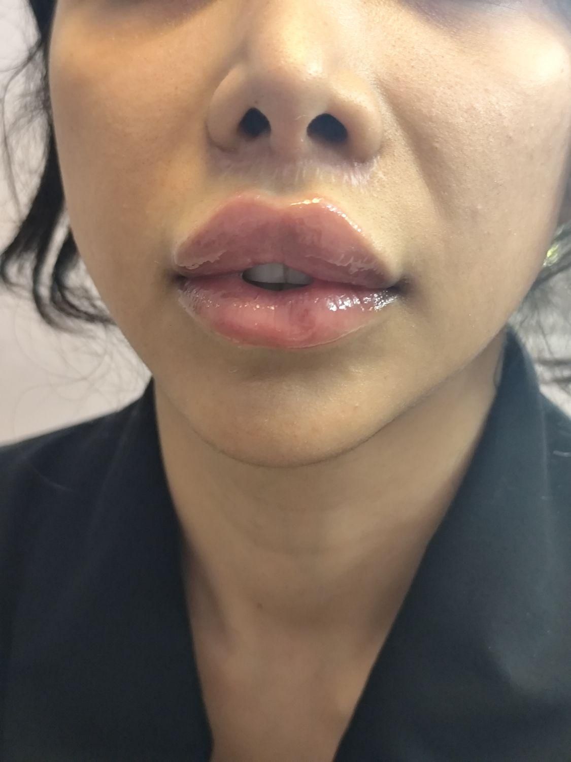 جشنواره  فیلر بادی،اگزوزوم، نخ،ژل بایوفیلرپی ار پی|خدمات آرایشگری و زیبایی|تهران, سعادت‌آباد|دیوار