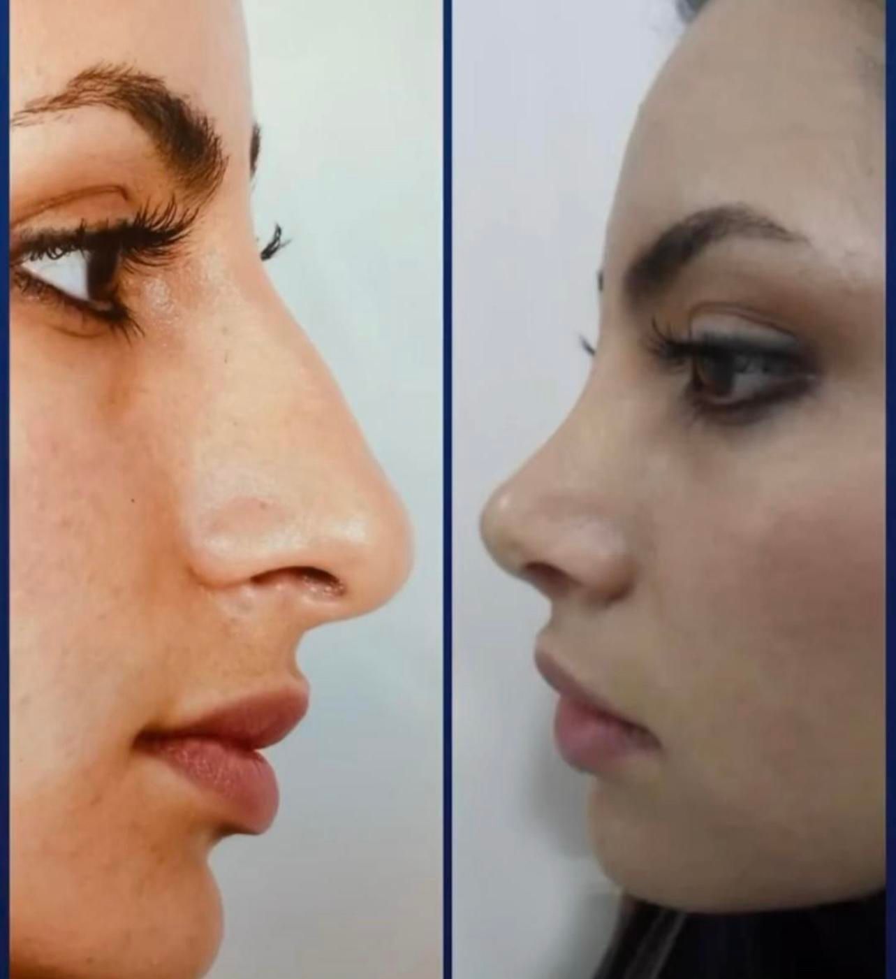 جراحی تیپ‌پلاستی بینی بصورت اقساط۱۸ ماهه|خدمات آرایشگری و زیبایی|خرم‌آباد, |دیوار