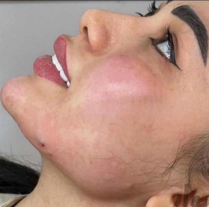 تزریق ژل لب و گونه و چانه.. (جشنواره)درمطب فقط499ت|خدمات آرایشگری و زیبایی|اصفهان, باغ زیار|دیوار