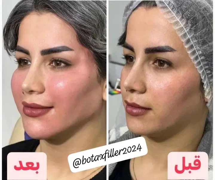 آموزش و خدمات تخصصی فیلر وبوتاکس|خدمات آموزشی|شیراز, معالی‌آباد|دیوار