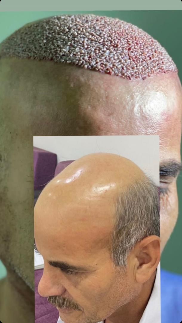 کاشت مو ابرو ریش تارکوب|خدمات آرایشگری و زیبایی|ورامین, |دیوار