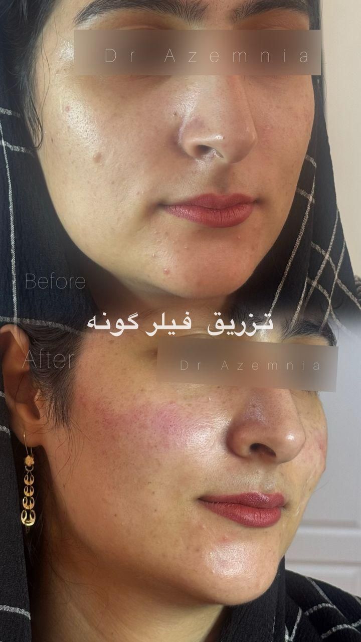 ژل ،بوتاکس لیزر مو رفع تتو پاکسازی هایفو توسط پزشک|خدمات آرایشگری و زیبایی|پرند, فاز ۲|دیوار
