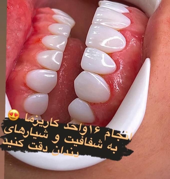 ٪۴۰ تخفیف کامپوزیت دندان اقساط ( بدون سود )|خدمات آرایشگری و زیبایی|شیراز, معالی‌آباد|دیوار