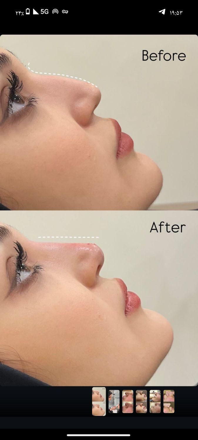 تزریق بوتاکس ژل فیلر|خدمات آرایشگری و زیبایی|تهران, صادقیه|دیوار