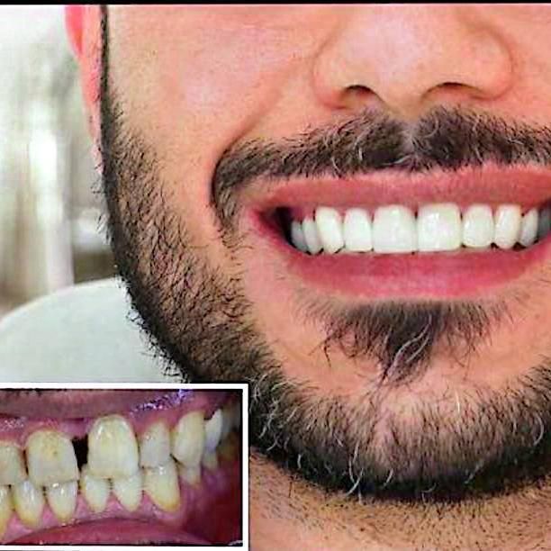 تخفیف فصلی کامپوزیت (1/500ت).عصب کشی در ایرانمهر|خدمات آرایشگری و زیبایی|یاسوج, |دیوار