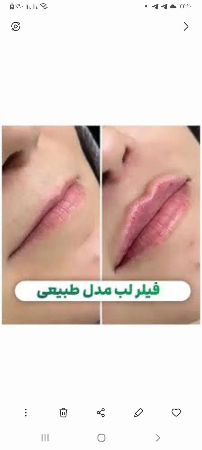 جشنواره تززیق فیلر،ژل وبوتاکس درهفده شهریور|خدمات آرایشگری و زیبایی|تبریز, |دیوار