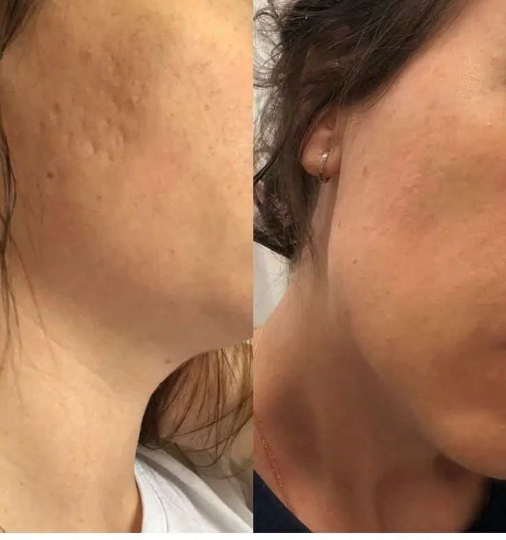 افرتابستانه از بین بردن تخصص جای جوش و اسکار پوستی|خدمات آرایشگری و زیبایی|شیراز, باهنر|دیوار
