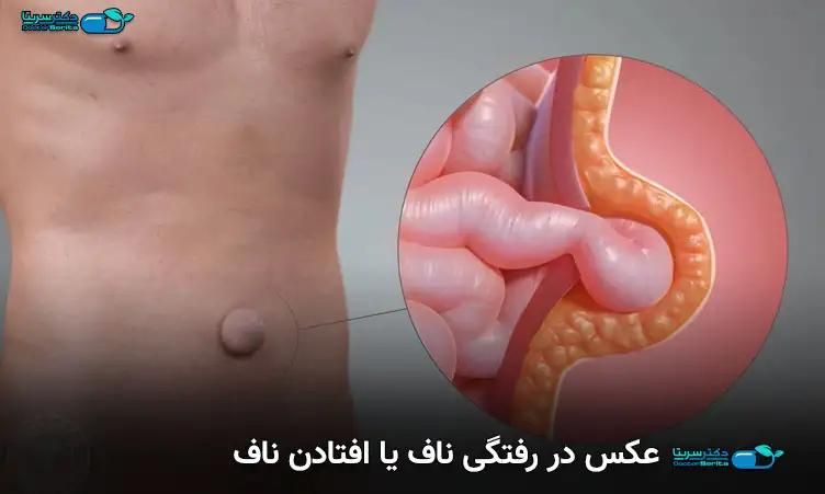 افتادگی ناف را رفع میکنیم|خدمات آرایشگری و زیبایی|اهواز, رسالت|دیوار