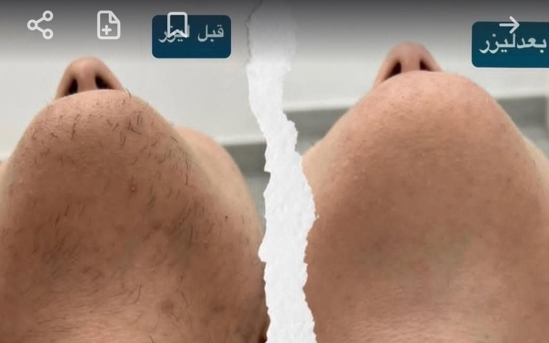 فیشال ولیزر مدیکا ژاندارمری|خدمات آرایشگری و زیبایی|اردبیل, |دیوار