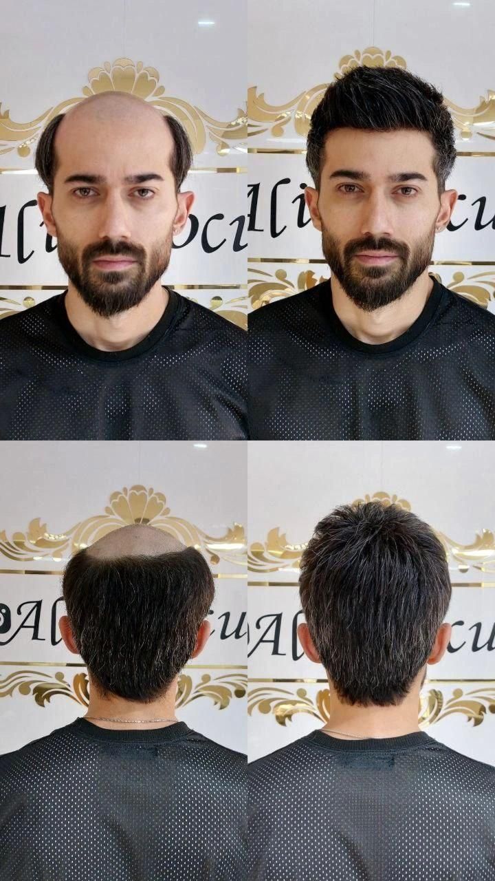 پروتزمو چسب ترمیم مو عمده و تک تهرانپارس تعویض چسب|خدمات آرایشگری و زیبایی|تهران, مهران (سیدخندان)|دیوار