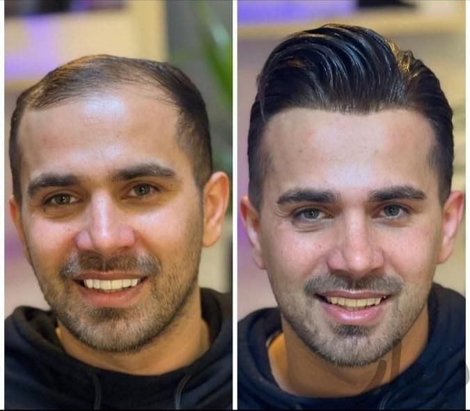 پروتز مو وارداتی ،کاشت hrt|خدمات آرایشگری و زیبایی|اصفهان, گلزار|دیوار