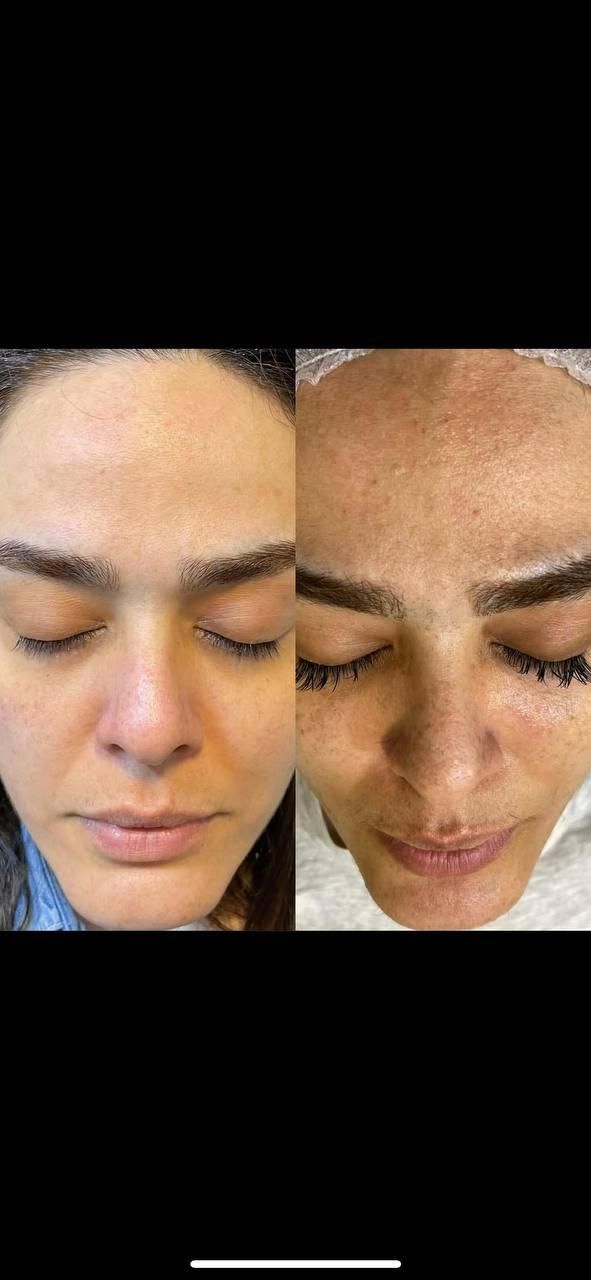 ریمو تتو.کربن ترابی صورت.روشن‌کردن نواحی تیره|خدمات آرایشگری و زیبایی|قم, باجک دو|دیوار
