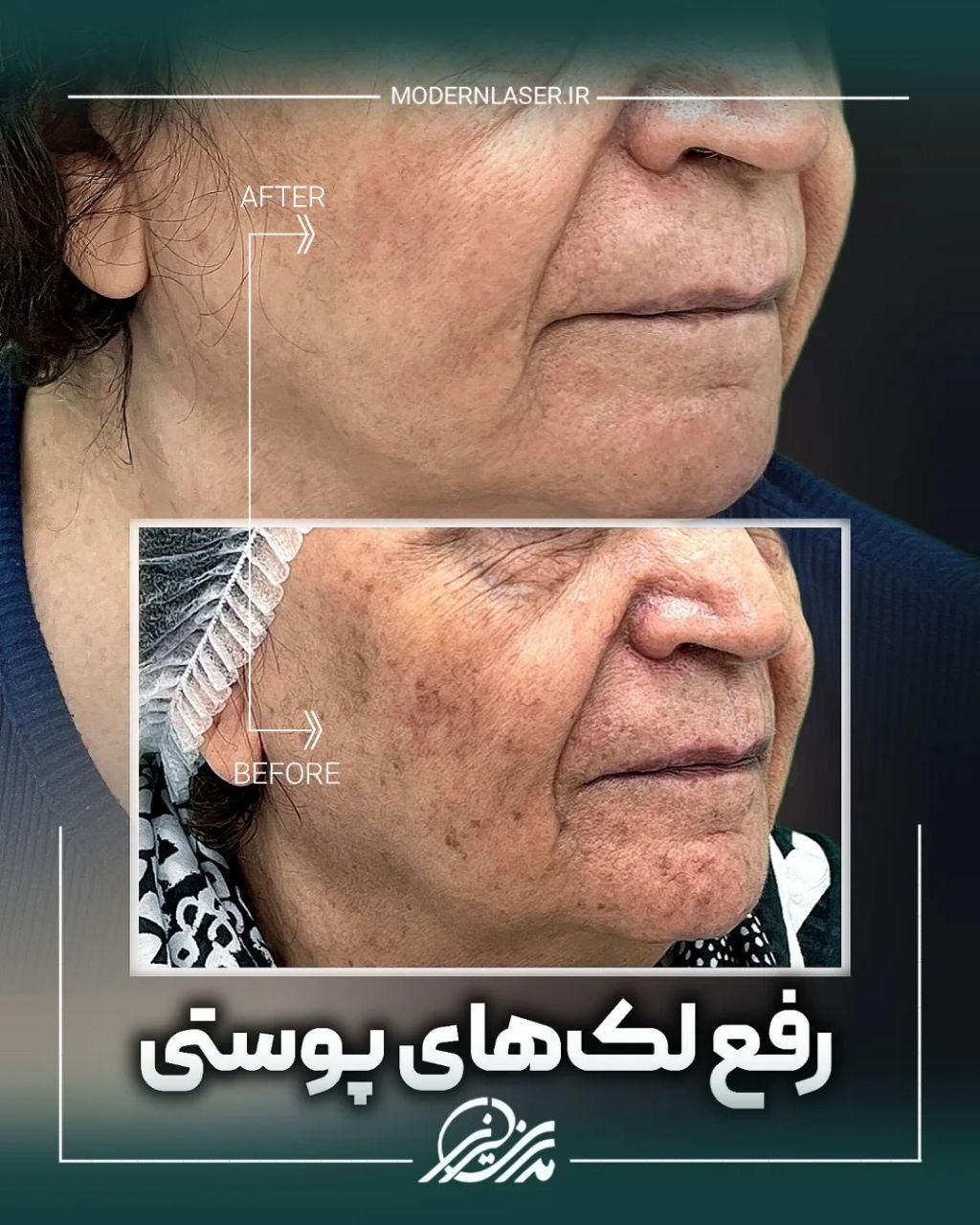 درمان کامل انواع لک پوستی توسط پزشک|خدمات آرایشگری و زیبایی|اصفهان, سعادت‌آباد|دیوار