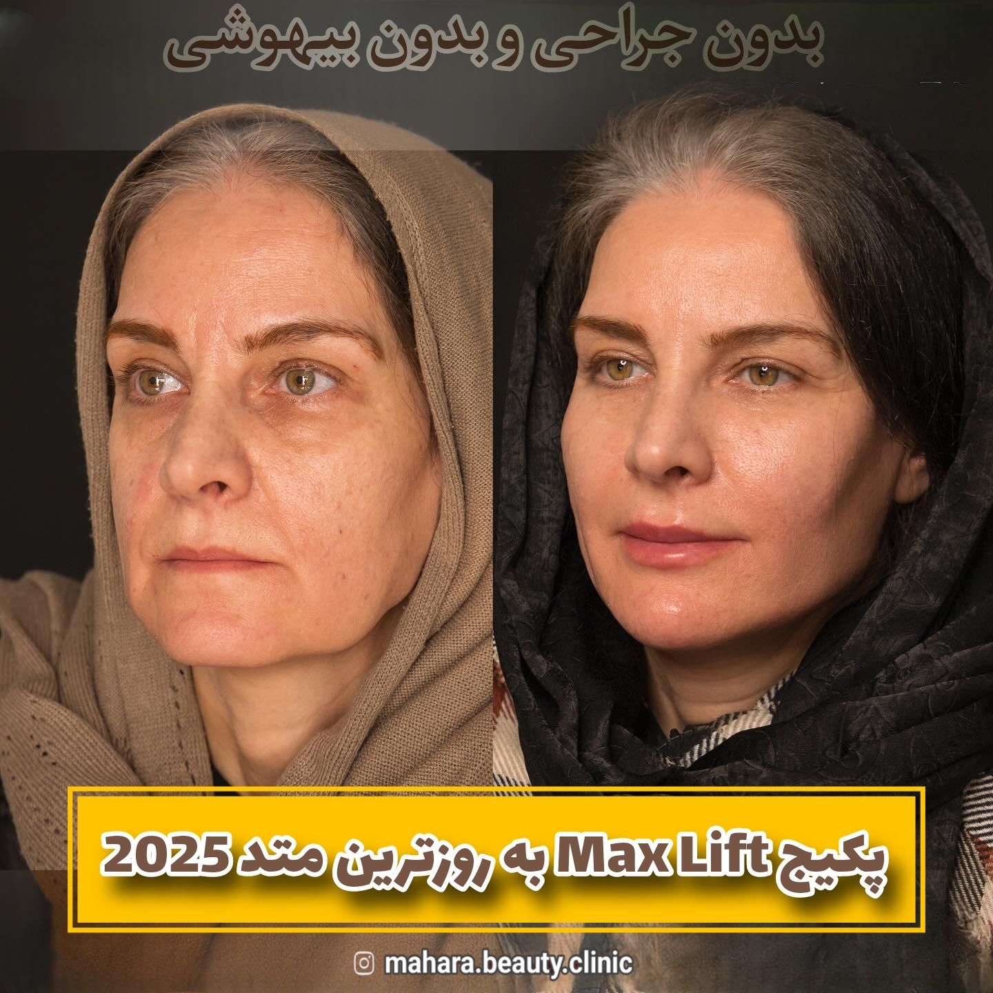 جشنواره جوانسازی Max Lift پزشک پوست مو بینی زیبایی|خدمات آرایشگری و زیبایی|مشهد, هفت تیر (حافظ)|دیوار