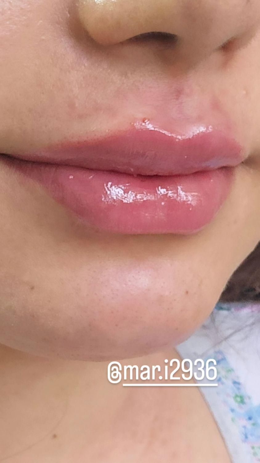 تزریق ژل و بوتاکس با تخفیف ویژه بهاری*|خدمات آرایشگری و زیبایی|جوانرود, |دیوار