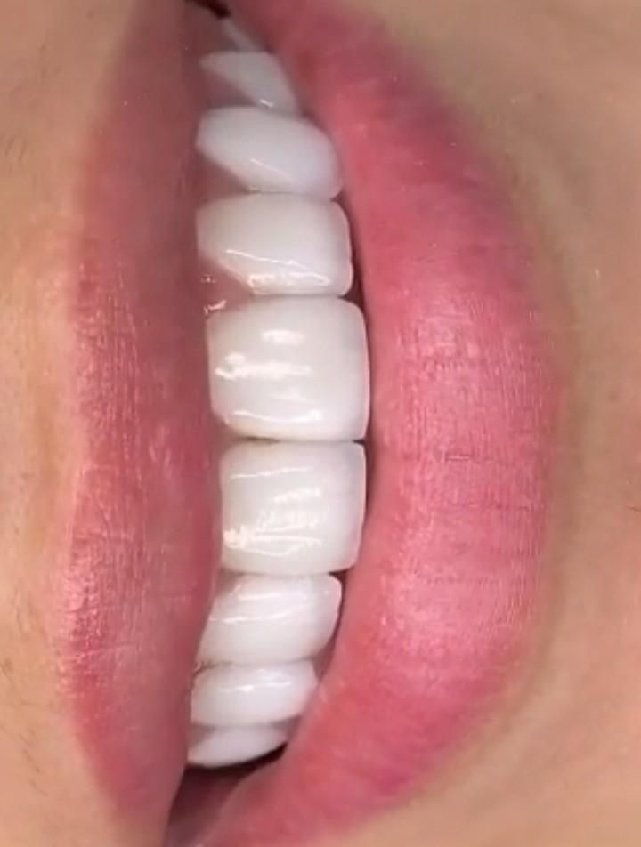 کامپوزیت دندان روکش دندانپزشک تهرانسر اکباتان خلیج|خدمات آرایشگری و زیبایی|تهران, تهرانسر شمالی|دیوار