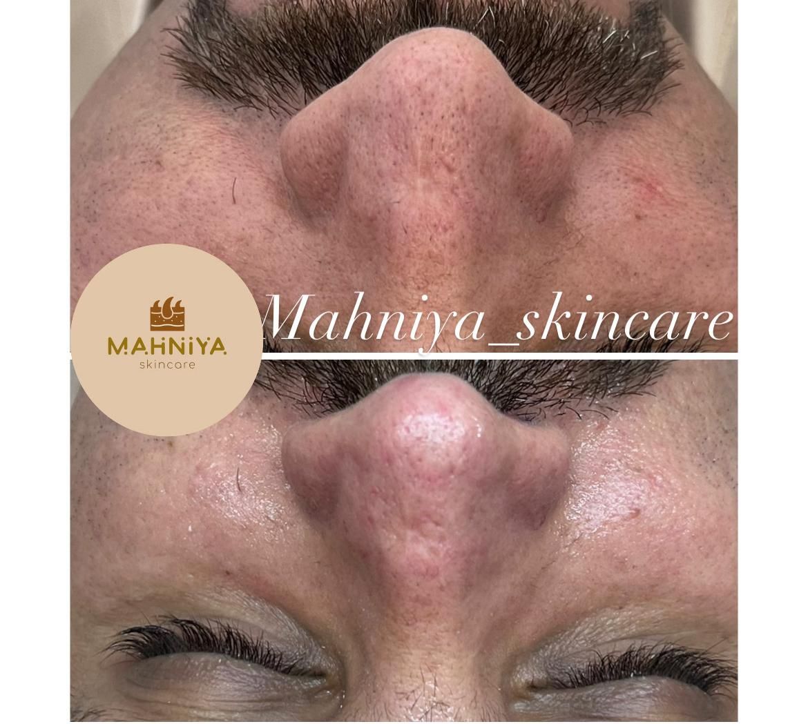 فیشال،آلگاپیل(پوست مار)هایفوتراپی،پوست کره ای|خدمات آرایشگری و زیبایی|قم, دورشهر|دیوار