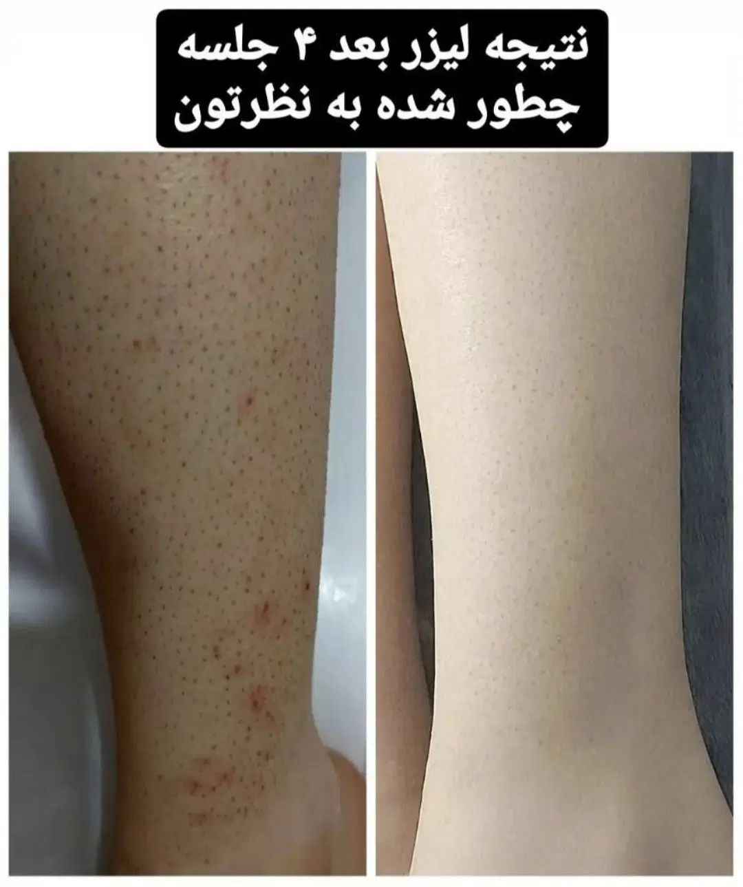 لیزرموزائد سوپرانوتیتانیوم آلما اصلی ۴۹۰تومن|خدمات آرایشگری و زیبایی|گرگان, |دیوار