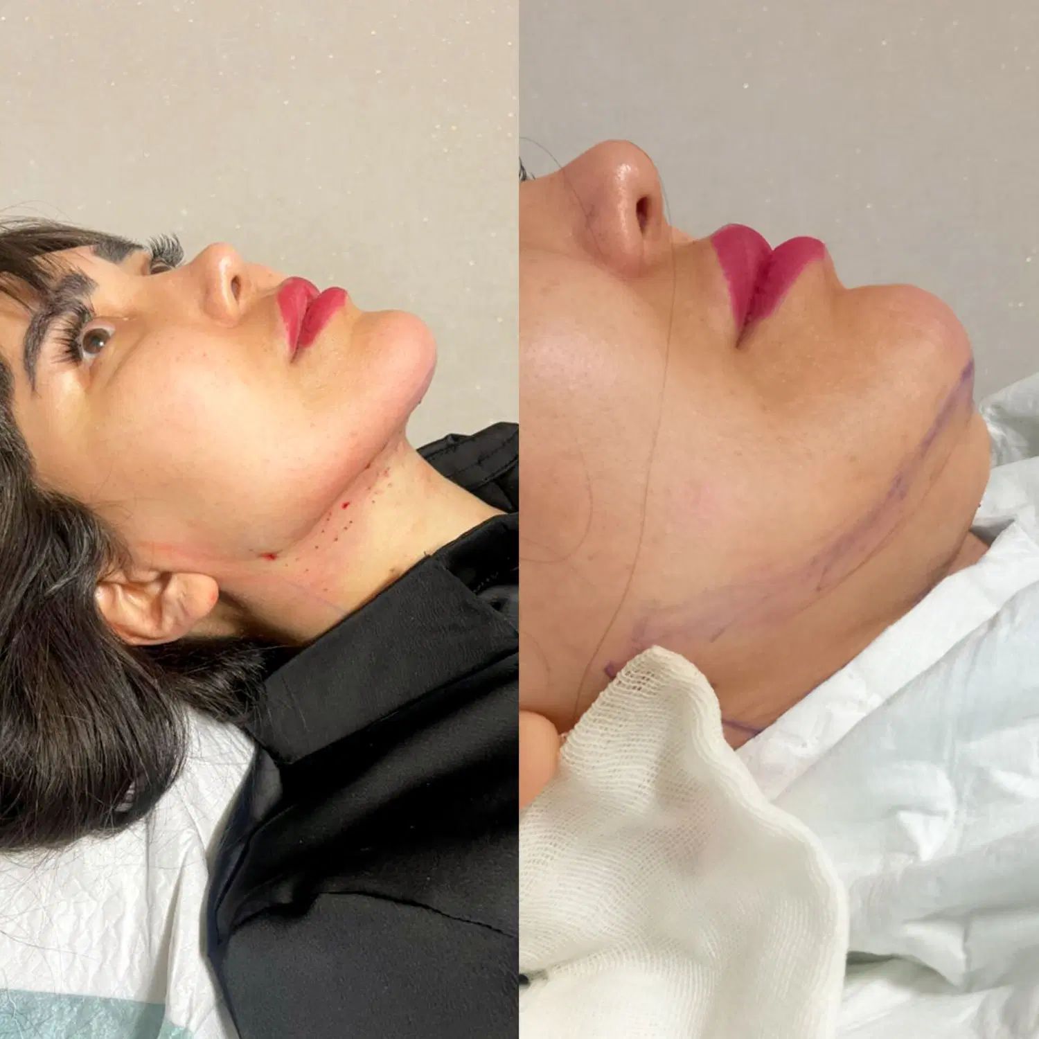لابیاپلاستی/واژینوپلاستی/بوکال فت/ساکشن غبغب/کاشت|خدمات آرایشگری و زیبایی|تهران, فرمانیه|دیوار