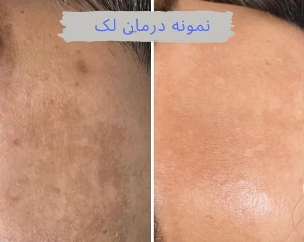 رویش مو (پی ارپی ، مزوتراپی )|خدمات آرایشگری و زیبایی|اهواز, پادادشهر|دیوار