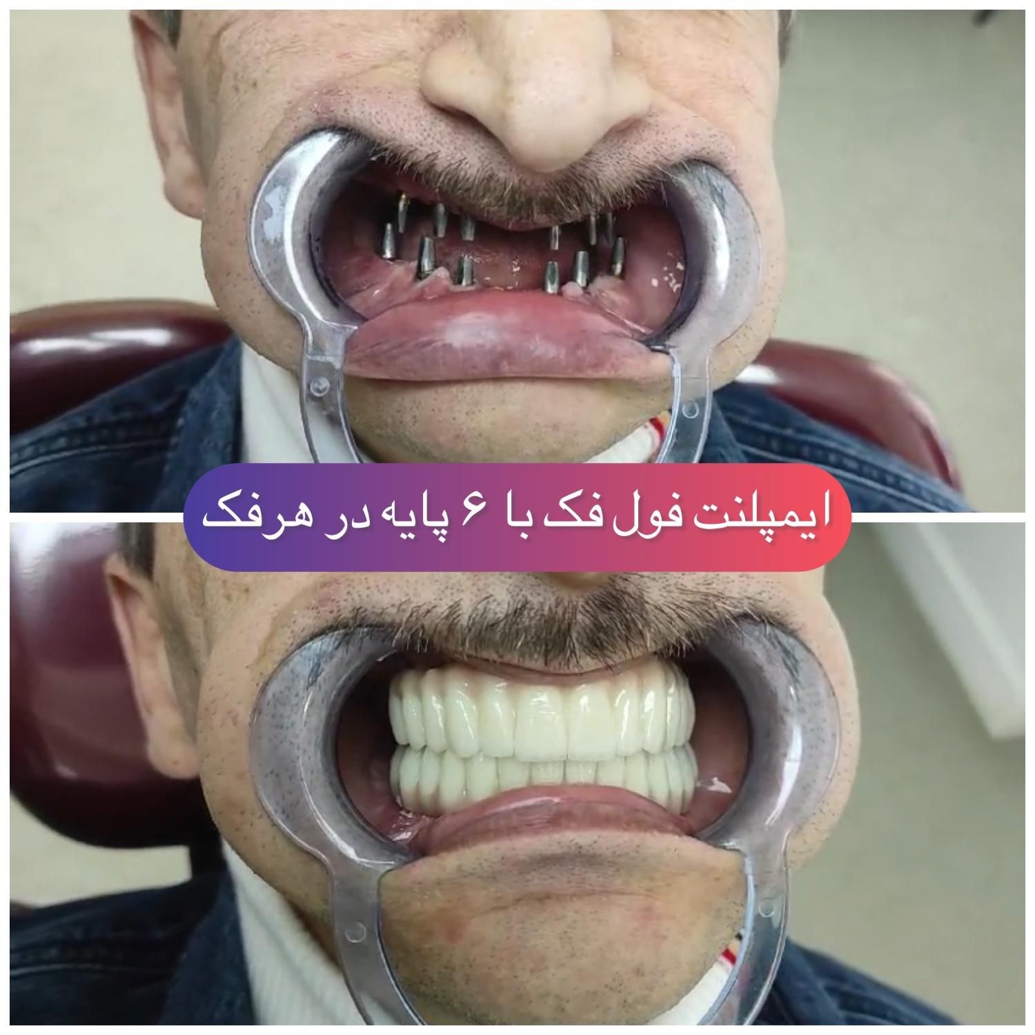 جشنواره ایمپلنت دندان به مدت محدود/دندانپزشکی|خدمات آرایشگری و زیبایی|تهران, خزانه|دیوار