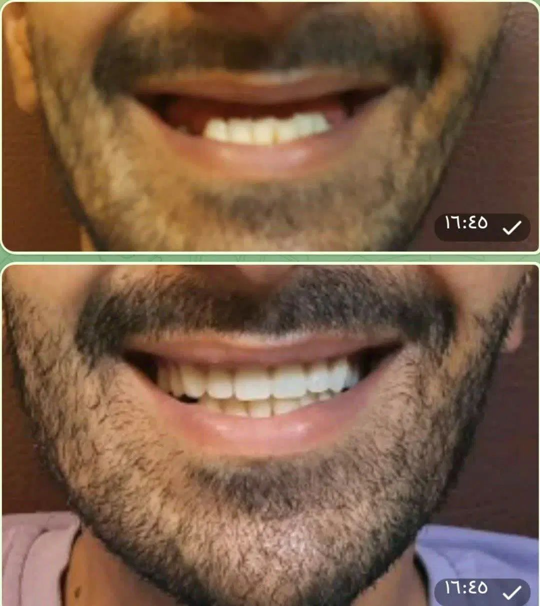 تعویض دندان مصنوعی قدیمی با دندان مصنوعی نو|آرایشی، بهداشتی، درمانی|شهرکرد, |دیوار