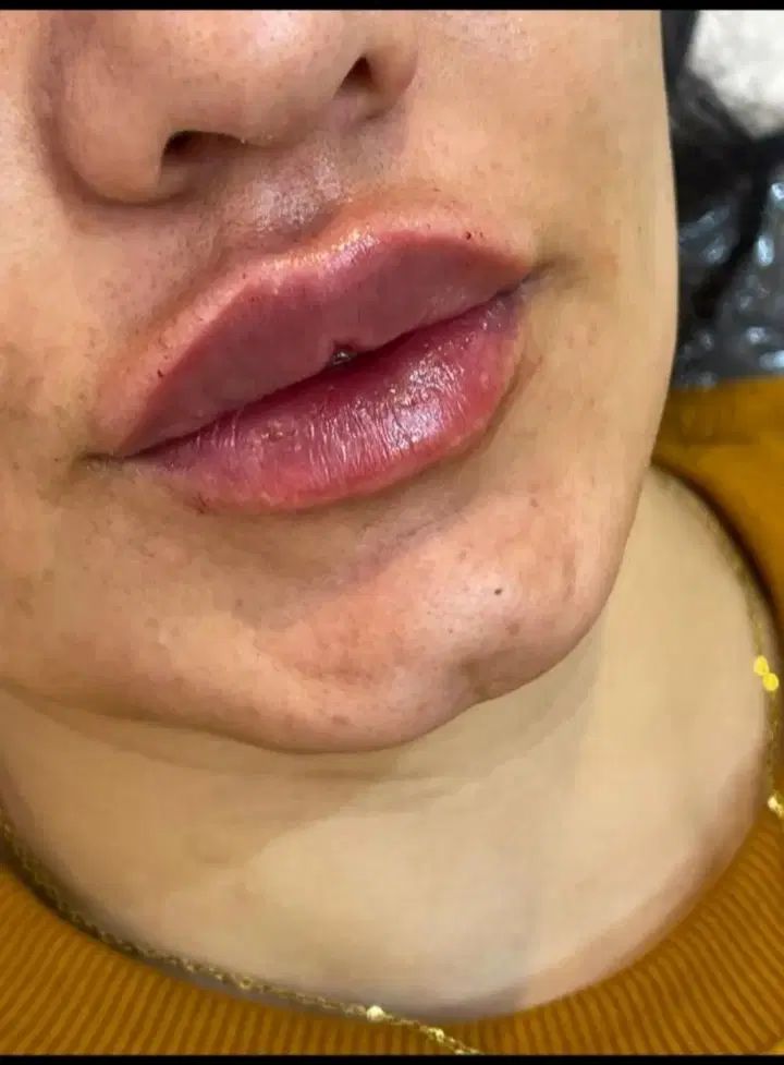 جشنواره تزریق بوتاکس وژل. فیلرکل صورت از ۷میلیون|خدمات آرایشگری و زیبایی|بردسیر, |دیوار