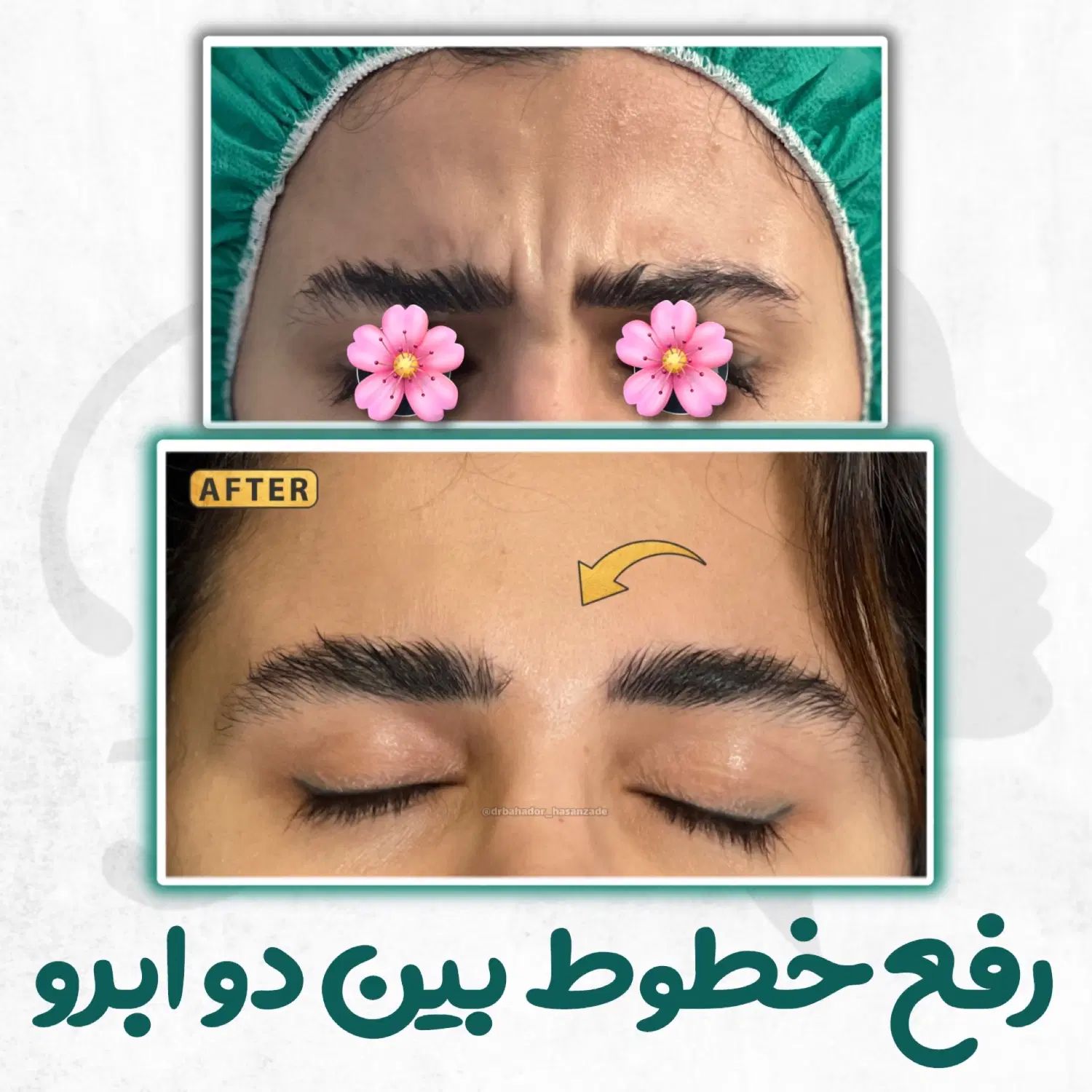 تزریق تخصصی بوتاکس صورت توسط پزشک، مطب زیبایی رشت|خدمات آرایشگری و زیبایی|رشت, گلسار|دیوار