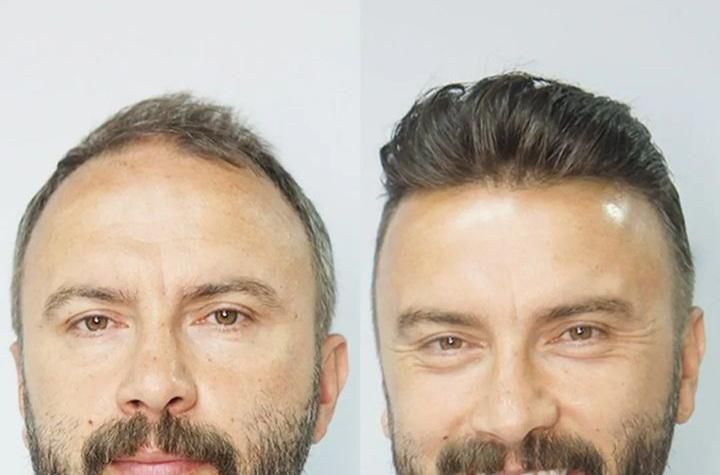 پروتز مو|خدمات آرایشگری و زیبایی|فردیس, طالقانی|دیوار