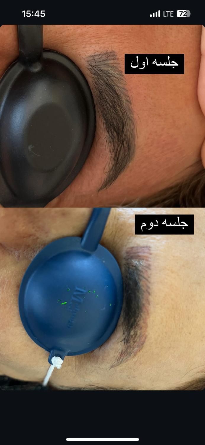 خدمات ریمو تتو،رفع کک و مک کلینک دکتر شریفی|خدمات آرایشگری و زیبایی|فولادشهر, B4|دیوار