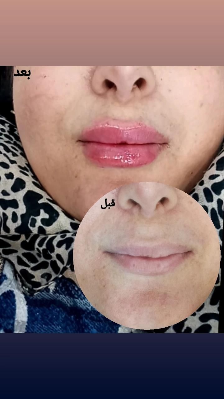 زیبایی ژل و بوتاکس|خدمات آرایشگری و زیبایی|اهواز, کیان اباد|دیوار
