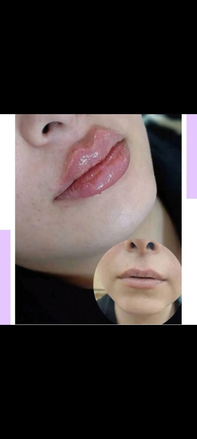 تزریق ژل و بوتاکس|خدمات آرایشگری و زیبایی|بیرجند, |دیوار