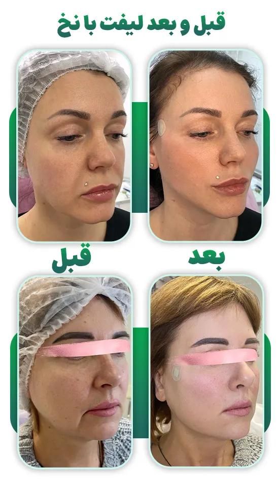 نیازمند مدل برای ترریق نخ لیفت یا جوان ساز|استخدام درمانی، زیبایی، بهداشتی|تنکابن, |دیوار