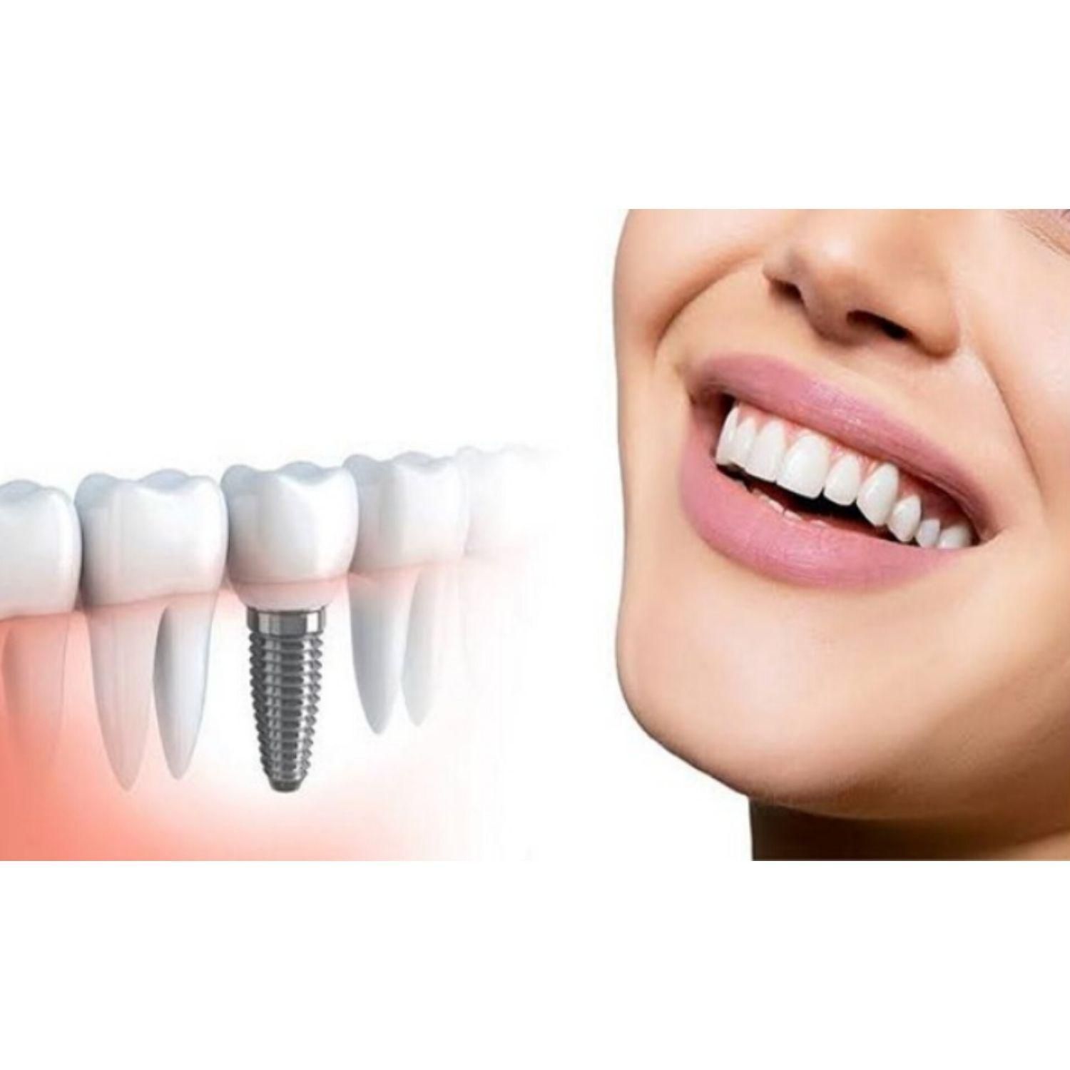 ایمپلنت دندان ۷۹۰۰ با ضمانت ۲۰ ساله|خدمات آرایشگری و زیبایی|کرج, عظیمیه|دیوار
