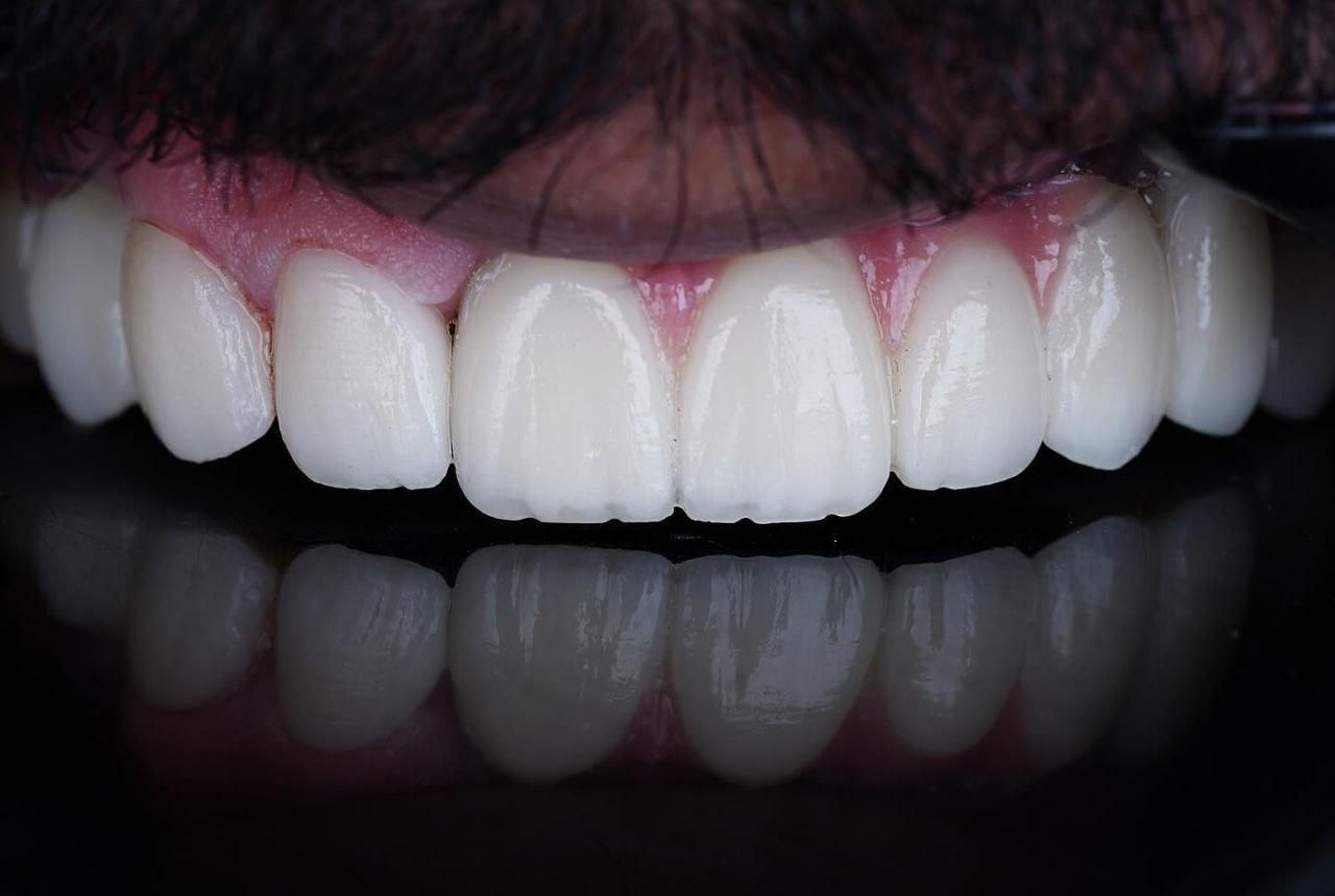 دندانپزشکی ایمپلنت کامپوزیت لمینیت روکش دندان|خدمات آرایشگری و زیبایی|تبریز, |دیوار