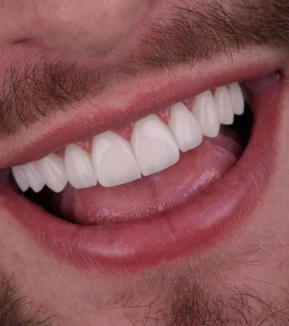 دندانپزشکی بدون پیش پرداخت عصب کشی . کامپوزیت و...|خدمات آرایشگری و زیبایی|قم, عمار یاسر|دیوار