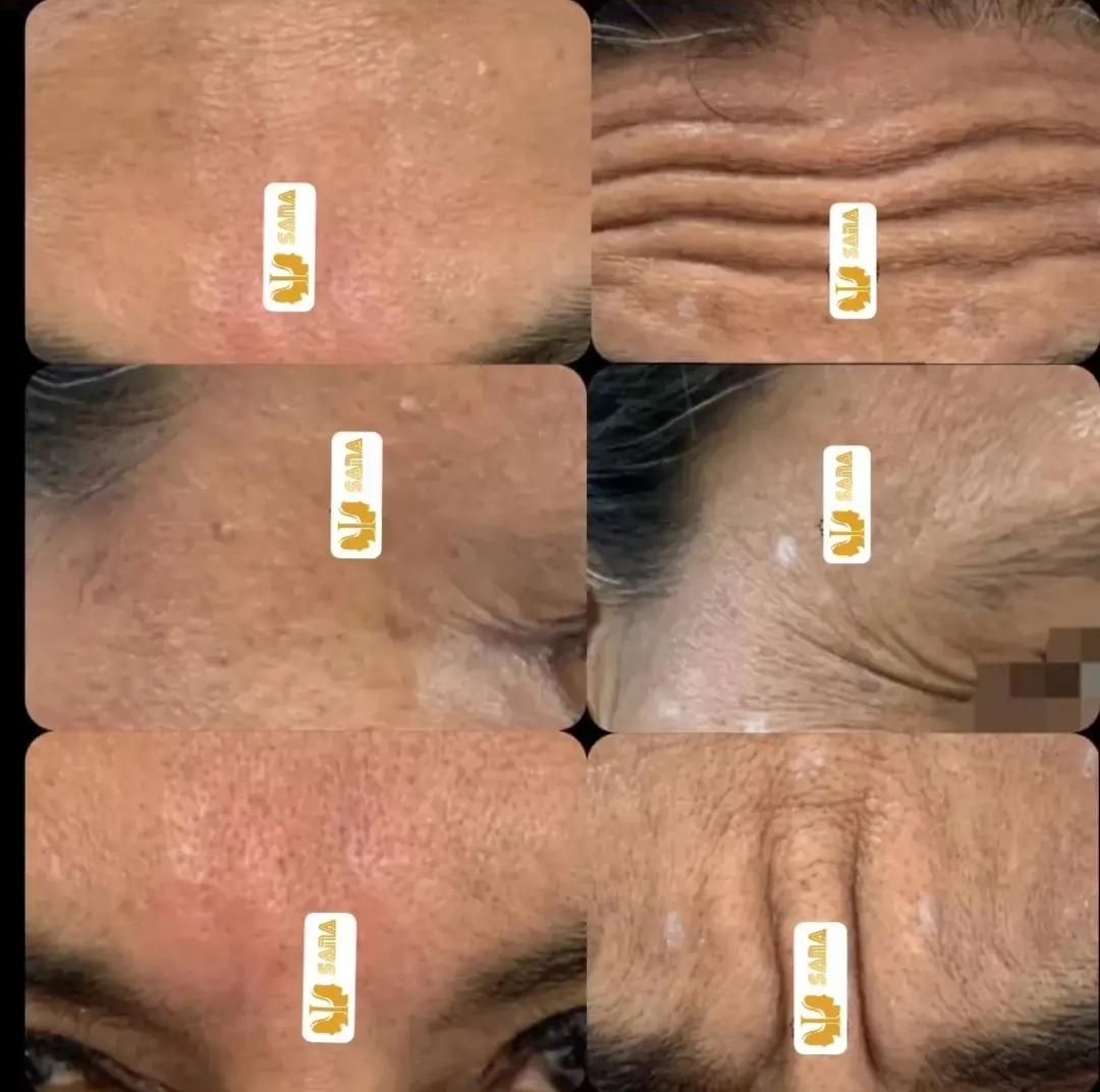 تزریق ژل و بوتاکس|خدمات آرایشگری و زیبایی|اهواز, نادری|دیوار