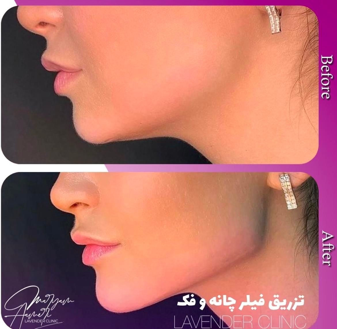 آموزش تزریق فیلر،بوتاکس و لیزر توسط پزشک|خدمات آموزشی|آمل, |دیوار