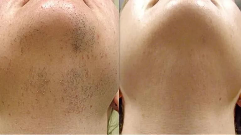 درمان کامل موبدن با لیزرالکس|خدمات آرایشگری و زیبایی|مشهد, شهید فرامرز عباسی|دیوار