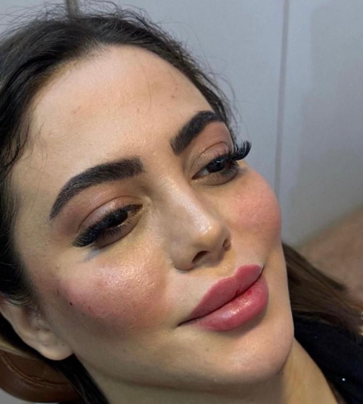 ژل لب روسی بوتاکس هیرفیلر کانتورینگ لیفت صورت|خدمات آرایشگری و زیبایی|تهران, دریا|دیوار